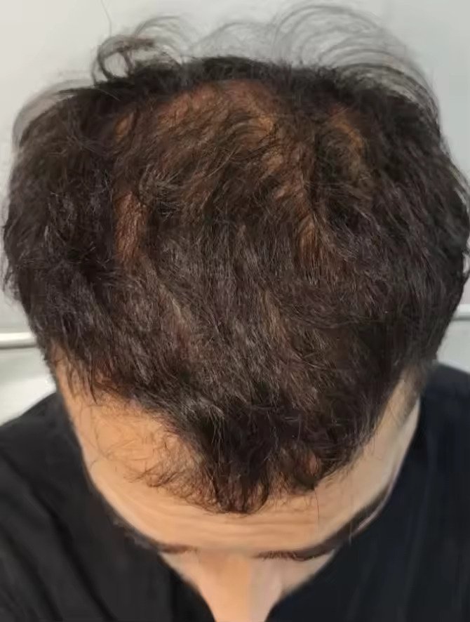 Resultado posterior de Héctor V.